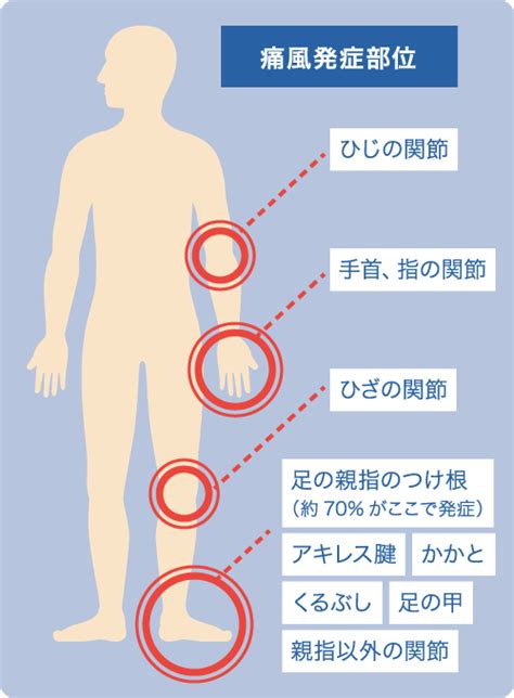 通風 女性|痛風の症状の特徴や痛みやすい場所とは？原因となる。